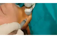 Biyopsi Sonucu Kaç Günde Çıkar?