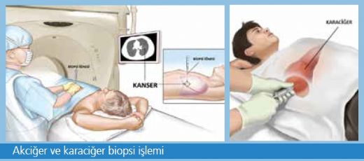 Akciğer Biyopsi Kimlere Yapılır?