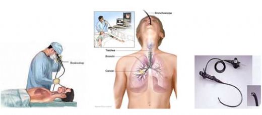 Akciğer Biyopsisi Nasıl Yapılır?