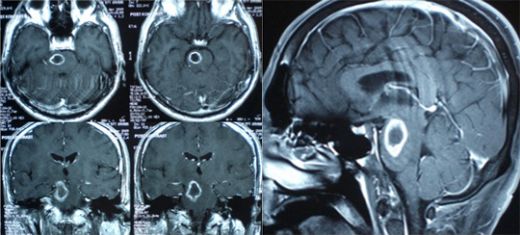 Beyin Biyopsisi Nasıl Yapılır?