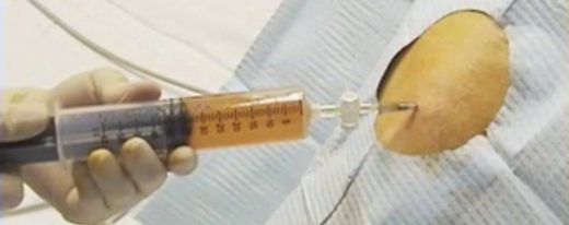 Biyopsi Nedir ve Nasıl Yapılır?