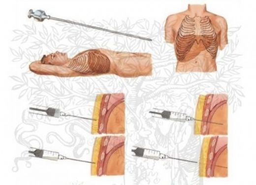 Biyopsi Karaciğer Hangi Amaçla Yapılır?