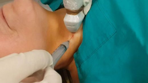 Boğazdan Biyopsi Nedir ve Nasıl Yapılır?