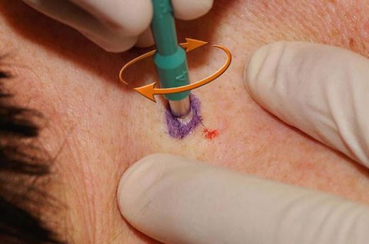 Eksizyonel Biyopsi Uygulaması