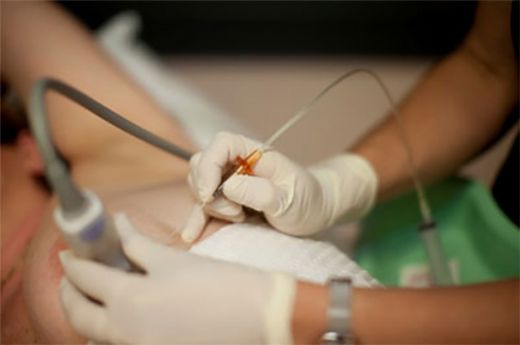 İğne Biyopsisi Nedir ve Nasıl Yapılır?