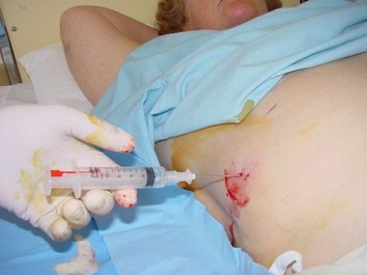 Karaciğer Biyopsisi Nasıl Yapılır?