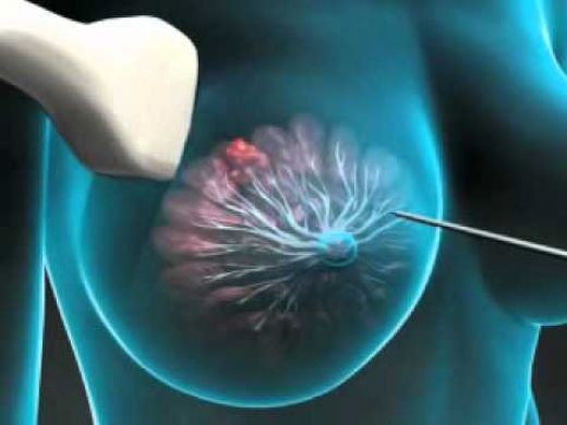 Meme Biyopsisi Nedir ve Nasıl Yapılır?