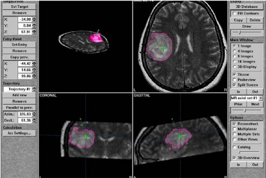 Stereotaktik Biyopsi Nedir ve Nasıl Yapılır?